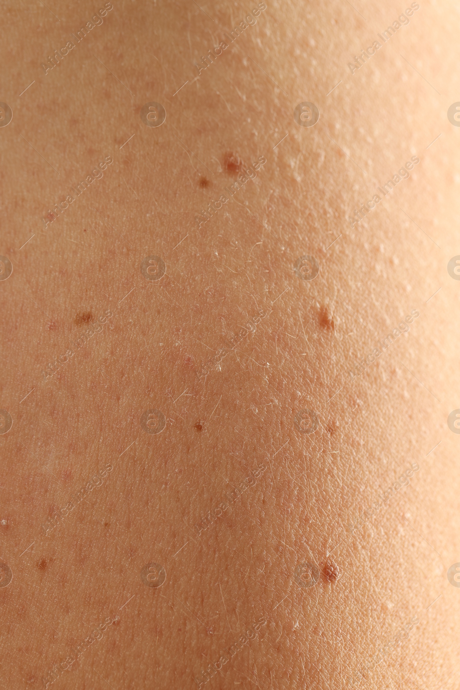 Woman with moles on her skin, closeup Photo of Woman with moles on her skin, closeup