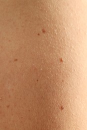 Photo of Woman with moles on her skin, closeup