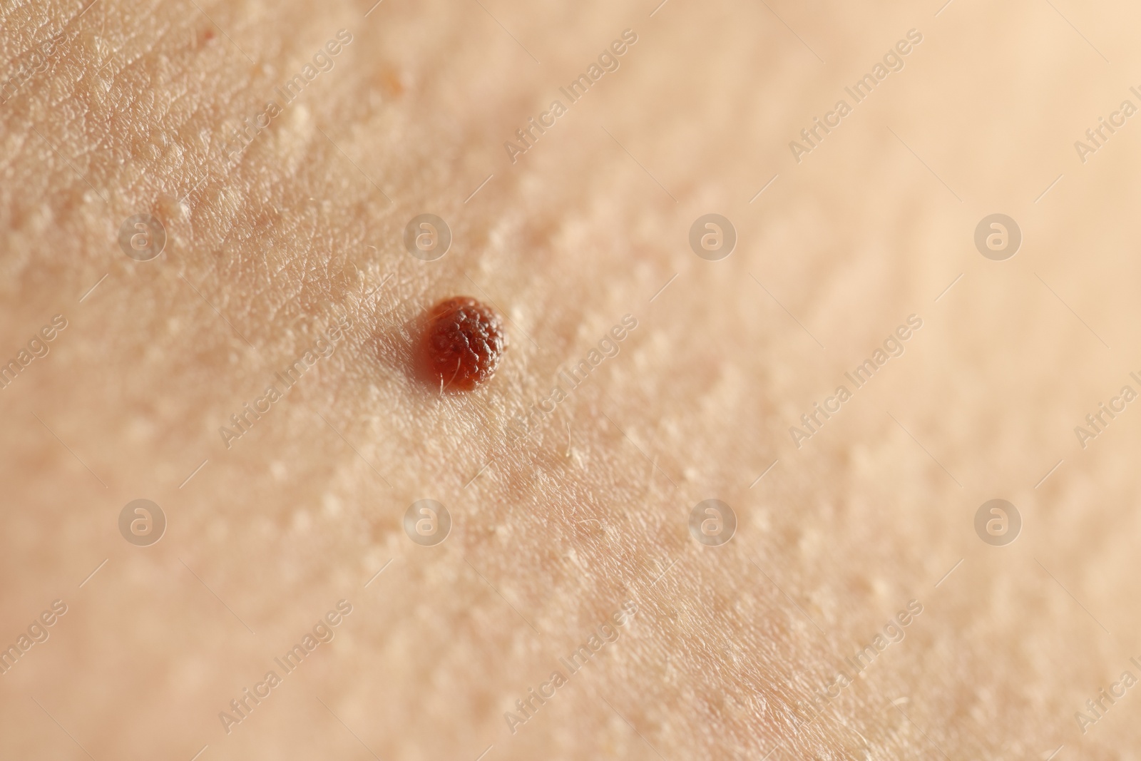Woman with mole on her skin, closeup Photo of Woman with mole on her skin, closeup