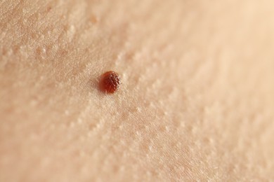 Photo of Woman with mole on her skin, closeup