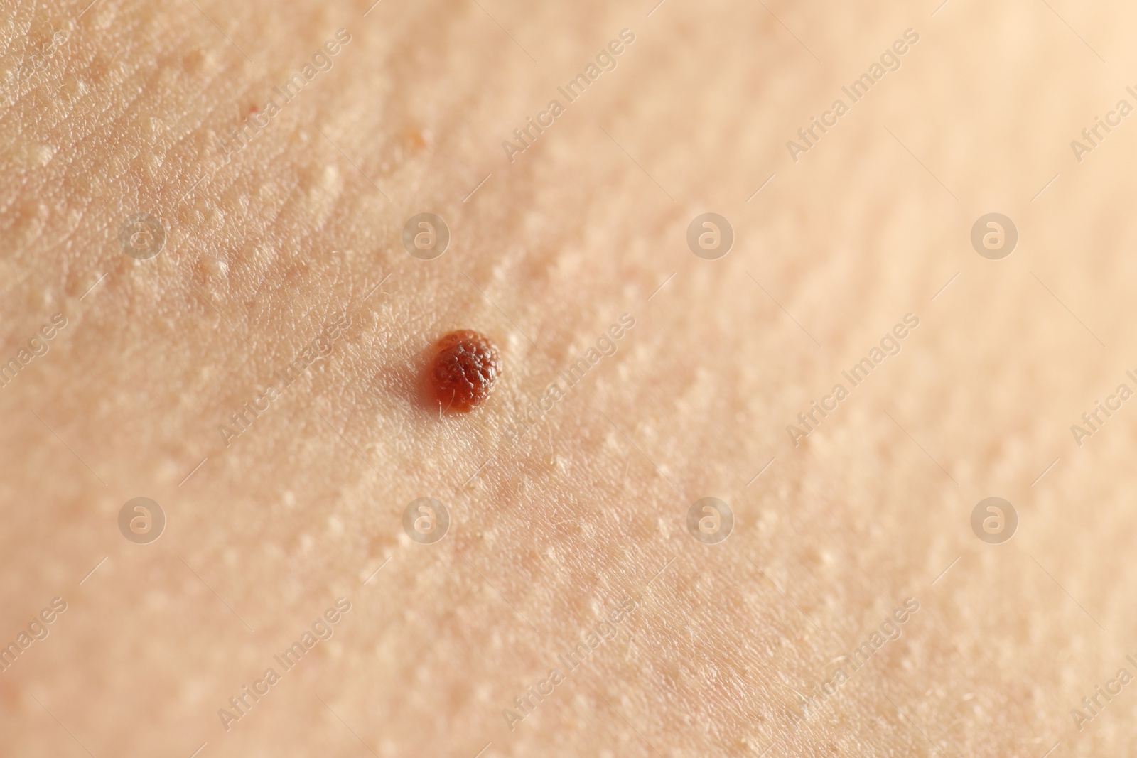 Woman with mole on her skin, closeup Photo of Woman with mole on her skin, closeup