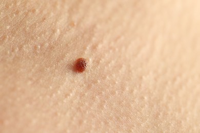 Photo of Woman with mole on her skin, closeup