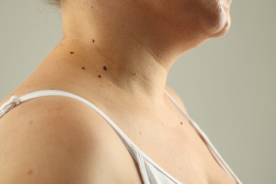 Photo of Woman with moles on her skin against grey background, closeup