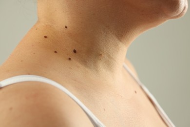 Photo of Woman with moles on her skin against grey background, closeup