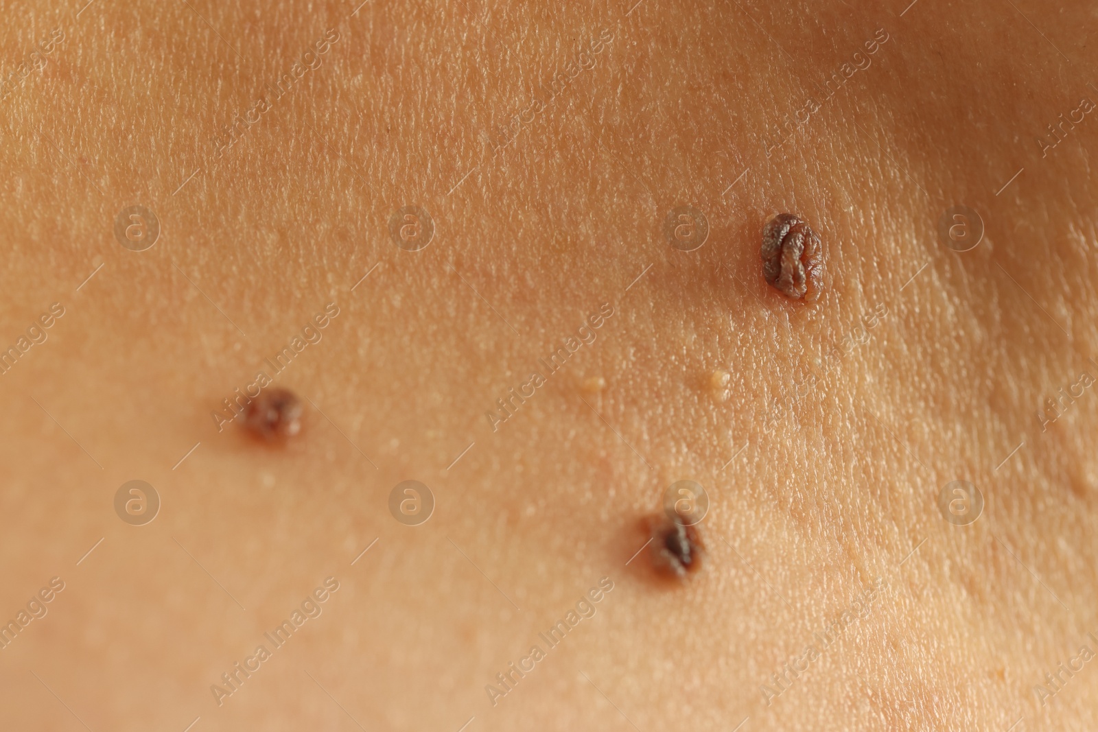 Woman with moles on her skin, closeup Photo of Woman with moles on her skin, closeup