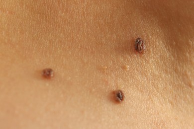 Photo of Woman with moles on her skin, closeup
