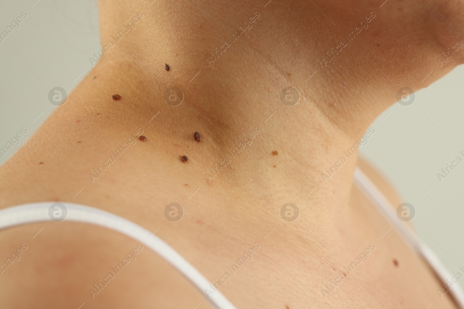 Woman with moles on her skin against grey background, closeup Photo of Woman with moles on her skin against grey background, closeup