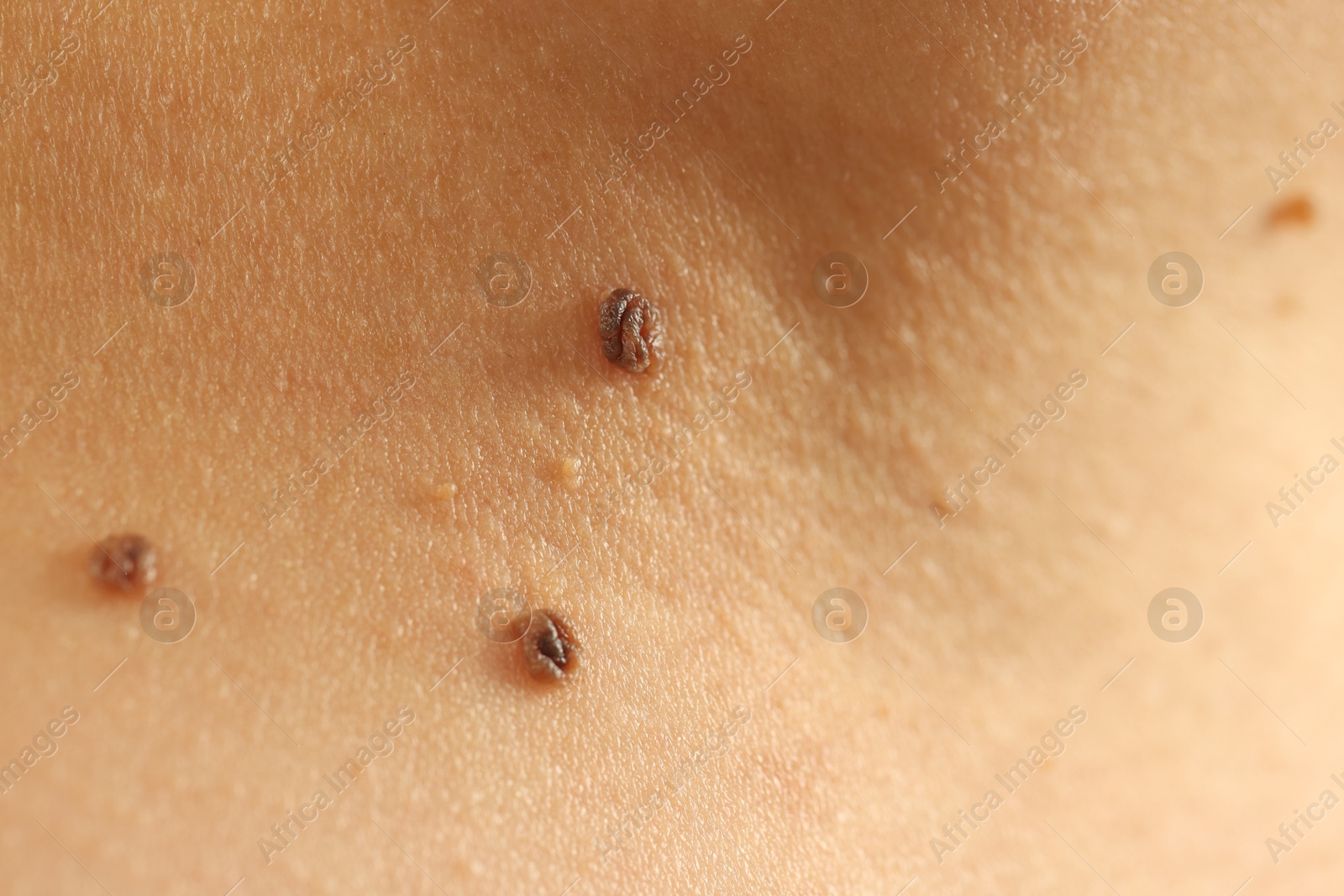 Woman with moles on her skin, closeup Photo of Woman with moles on her skin, closeup