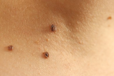 Photo of Woman with moles on her skin, closeup