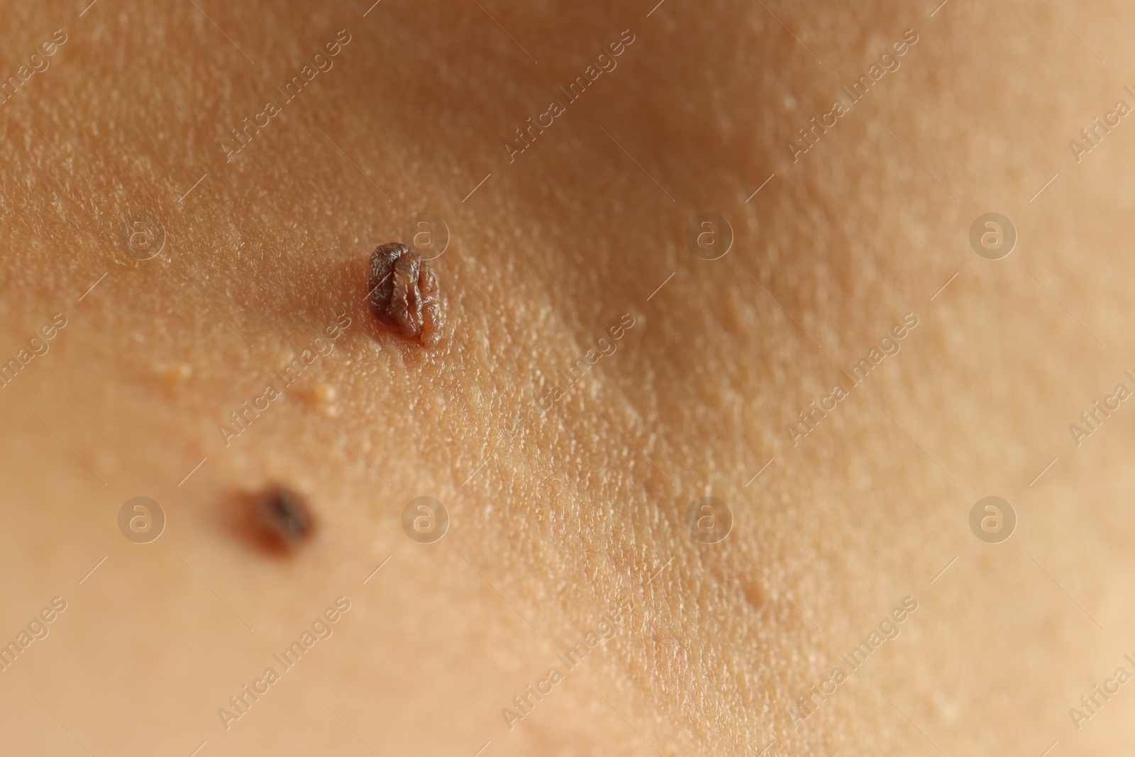 Woman with moles on her skin, closeup Photo of Woman with moles on her skin, closeup