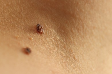 Photo of Woman with moles on her skin, closeup