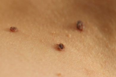 Photo of Woman with moles on her skin, closeup