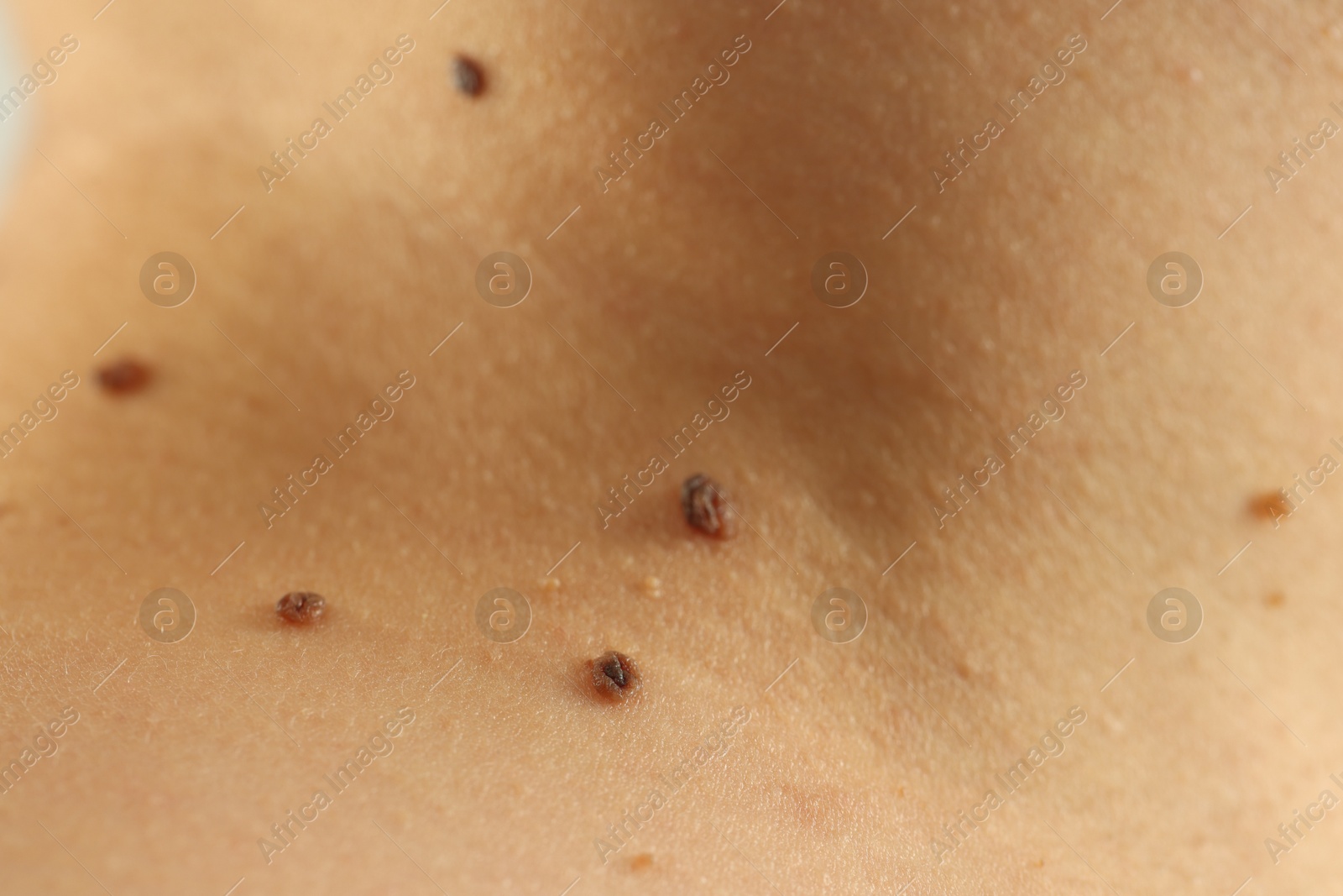 Woman with moles on her skin, closeup Photo of Woman with moles on her skin, closeup
