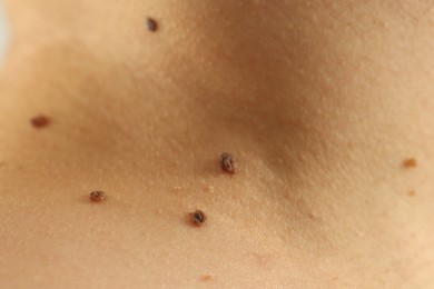 Photo of Woman with moles on her skin, closeup