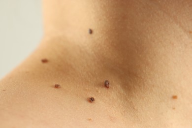Photo of Woman with moles on her skin against grey background, closeup