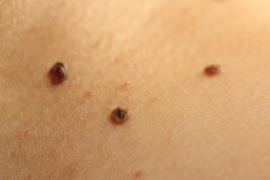 Photo of Woman with moles on her skin, closeup