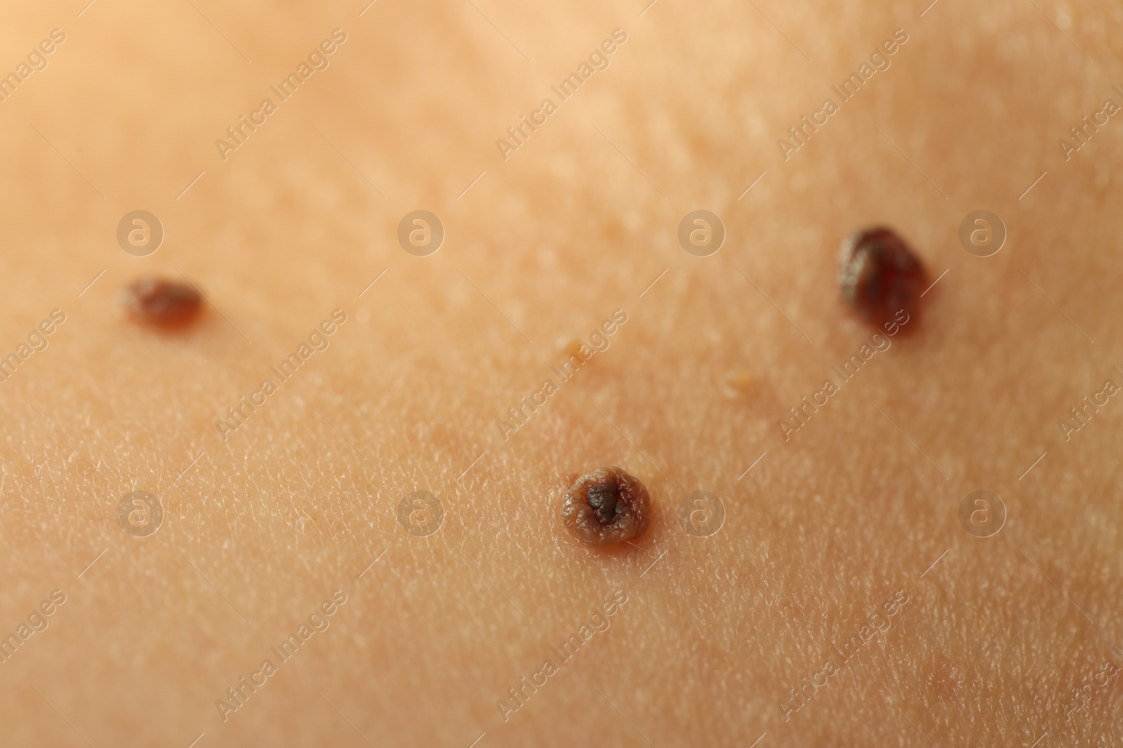 Photo of Woman with moles on her skin, closeup