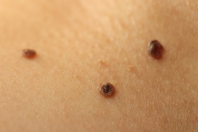 Photo of Woman with moles on her skin, closeup