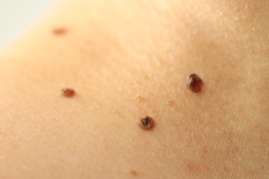Photo of Woman with moles on her skin, closeup