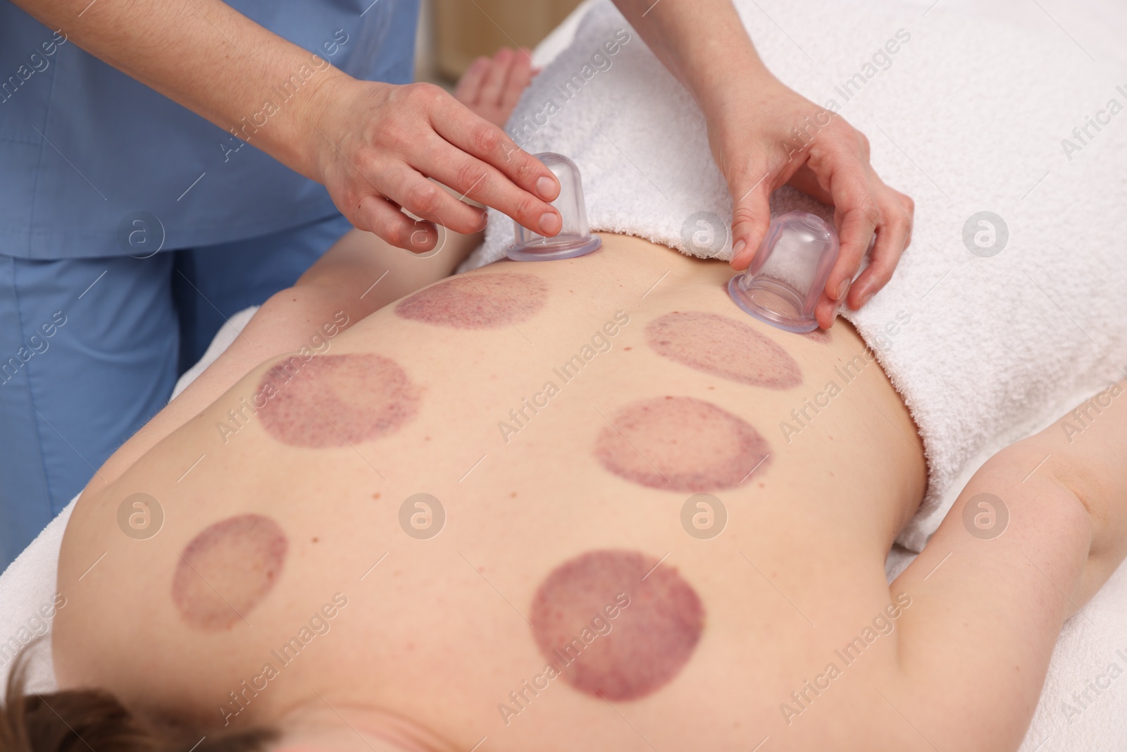 Therapist giving cupping treatment to patient in spa salon, closeup Photo of Therapist giving cupping treatment to patient in spa salon, closeup