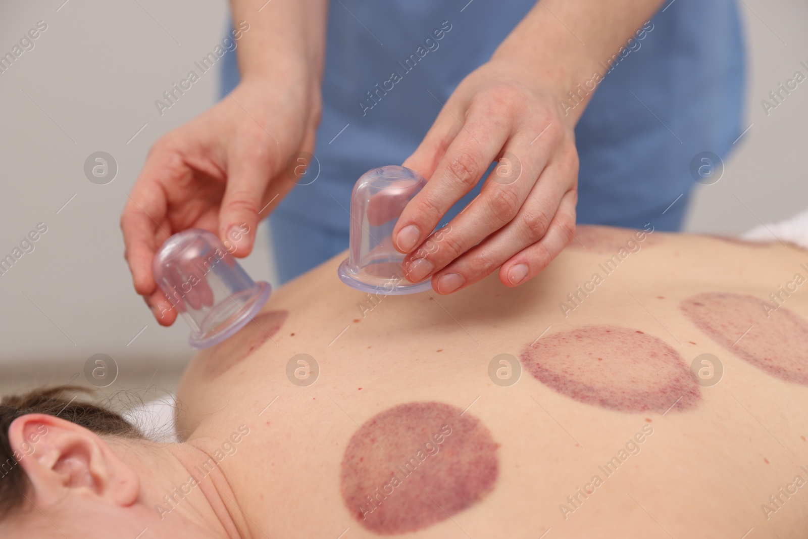 Therapist giving cupping treatment to patient in spa salon, closeup Photo of Therapist giving cupping treatment to patient in spa salon, closeup