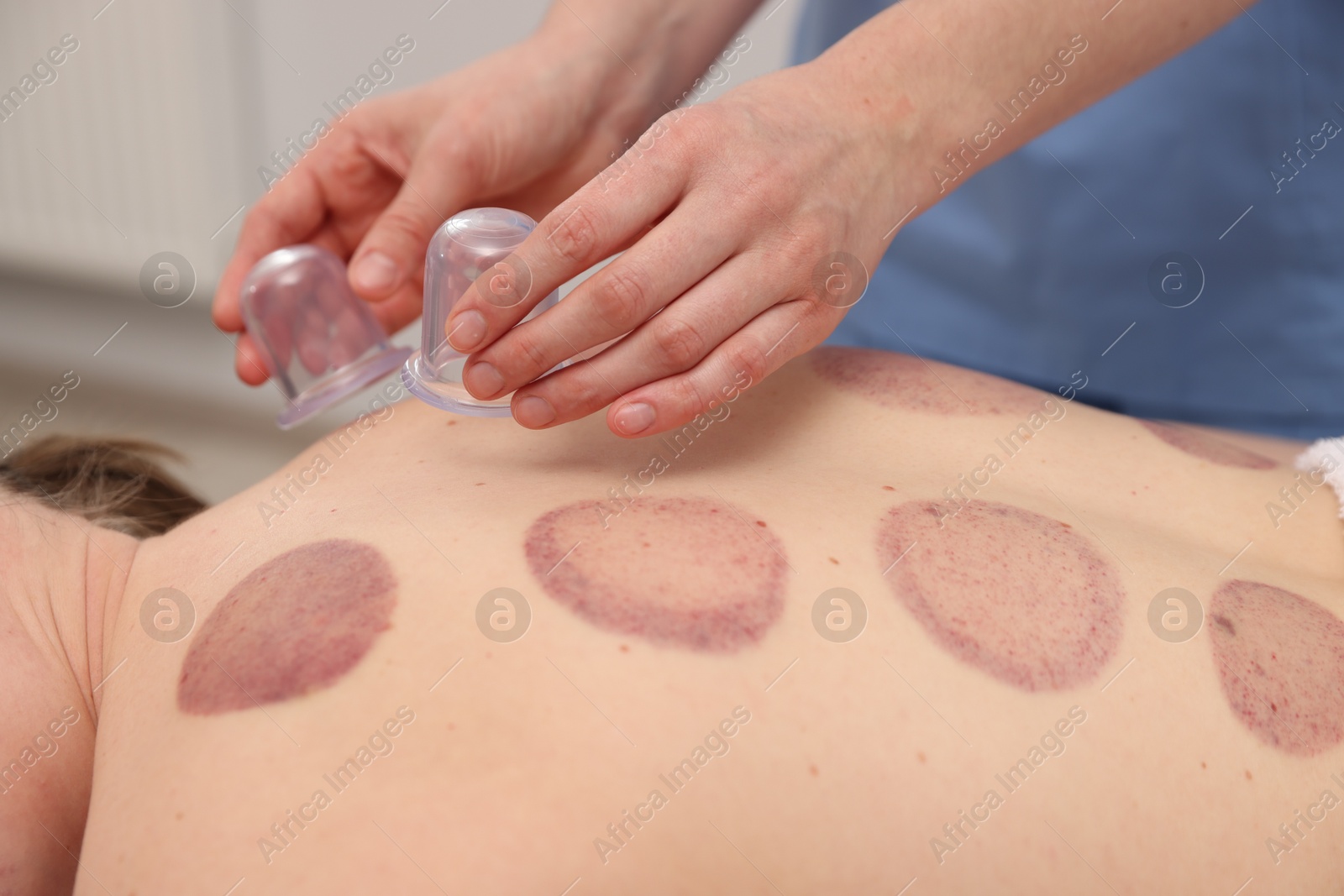 Therapist giving cupping treatment to patient in spa salon, closeup Photo of Therapist giving cupping treatment to patient in spa salon, closeup