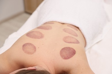 Photo of Woman after cupping therapy in spa salon, closeup
