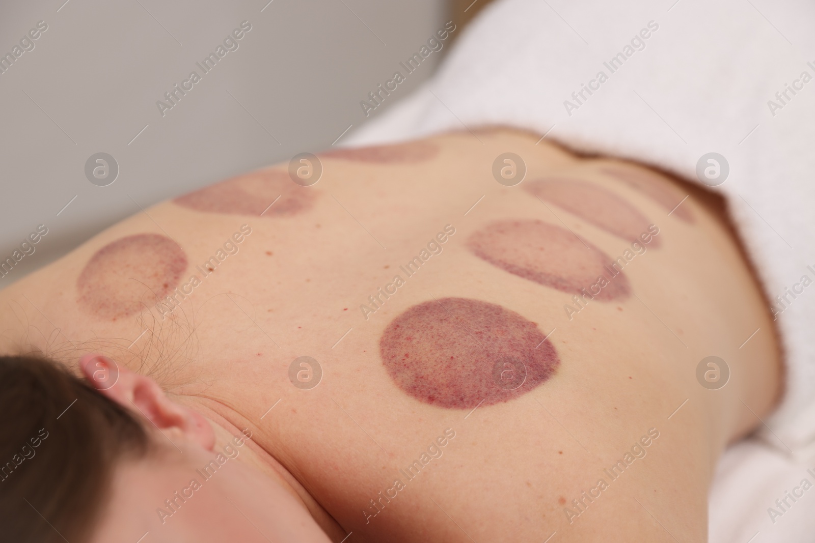 Woman after cupping therapy in spa salon, closeup Photo of Woman after cupping therapy in spa salon, closeup