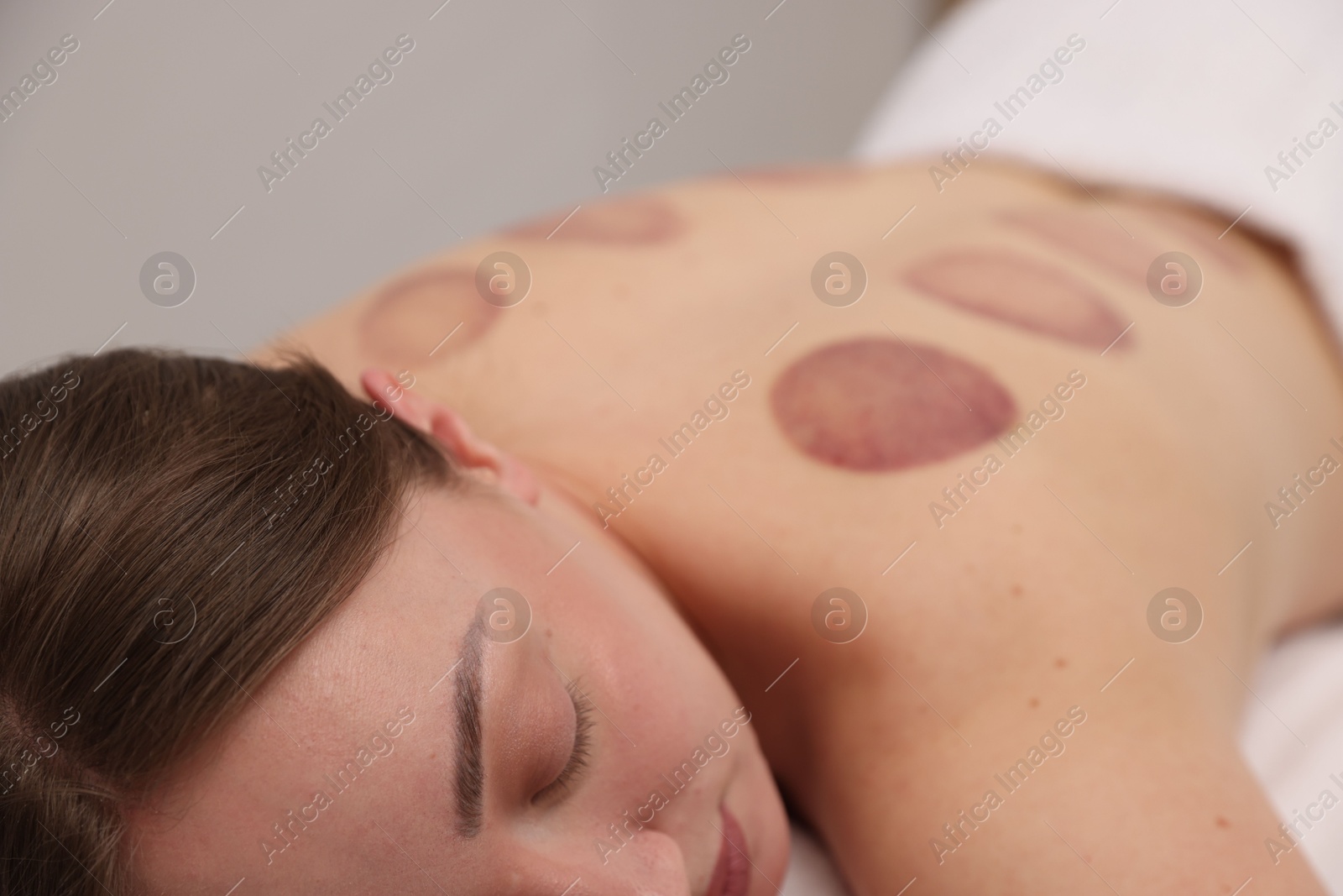 Woman after cupping therapy in spa salon, closeup Photo of Woman after cupping therapy in spa salon, closeup