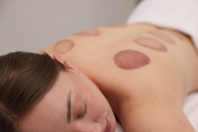 Photo of Woman after cupping therapy in spa salon, closeup