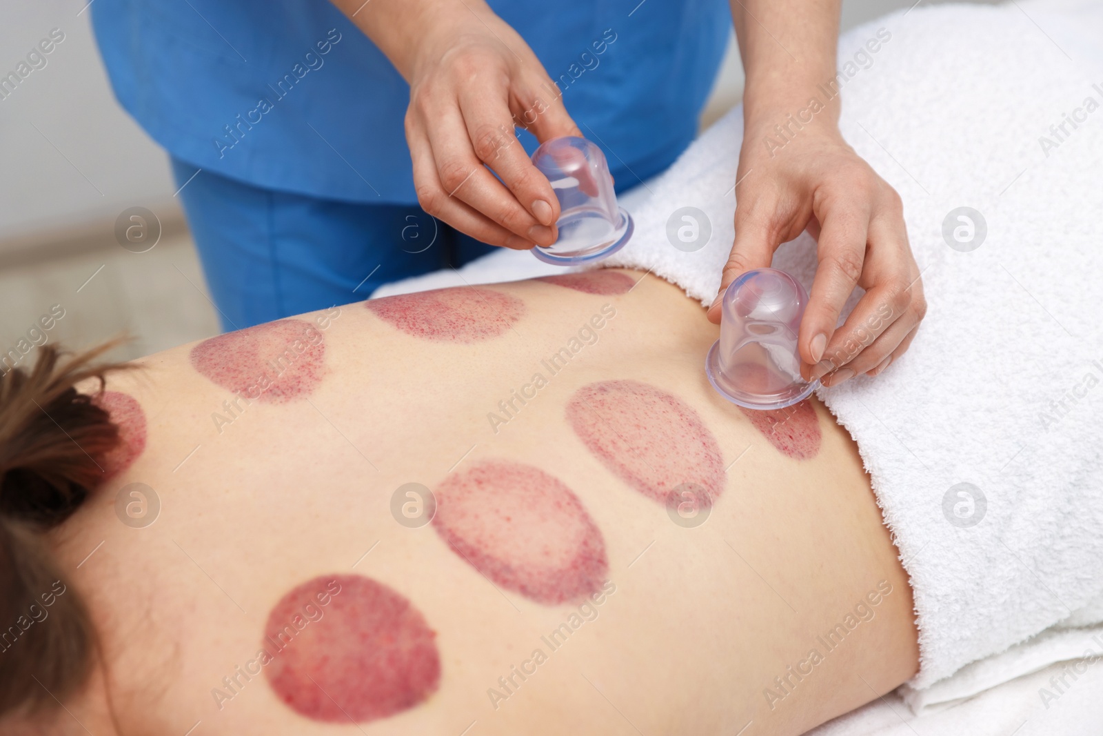 Therapist giving cupping treatment to patient in spa salon, closeup Photo of Therapist giving cupping treatment to patient in spa salon, closeup