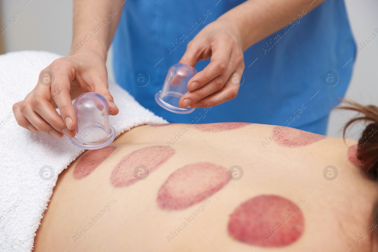 Therapist giving cupping treatment to patient in spa salon, closeup Photo of Therapist giving cupping treatment to patient in spa salon, closeup