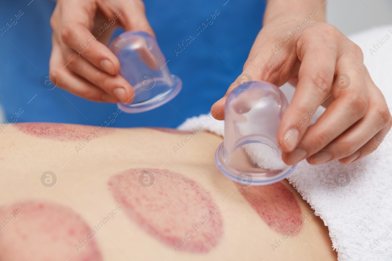 Therapist giving cupping treatment to patient in spa salon, closeup Photo of Therapist giving cupping treatment to patient in spa salon, closeup