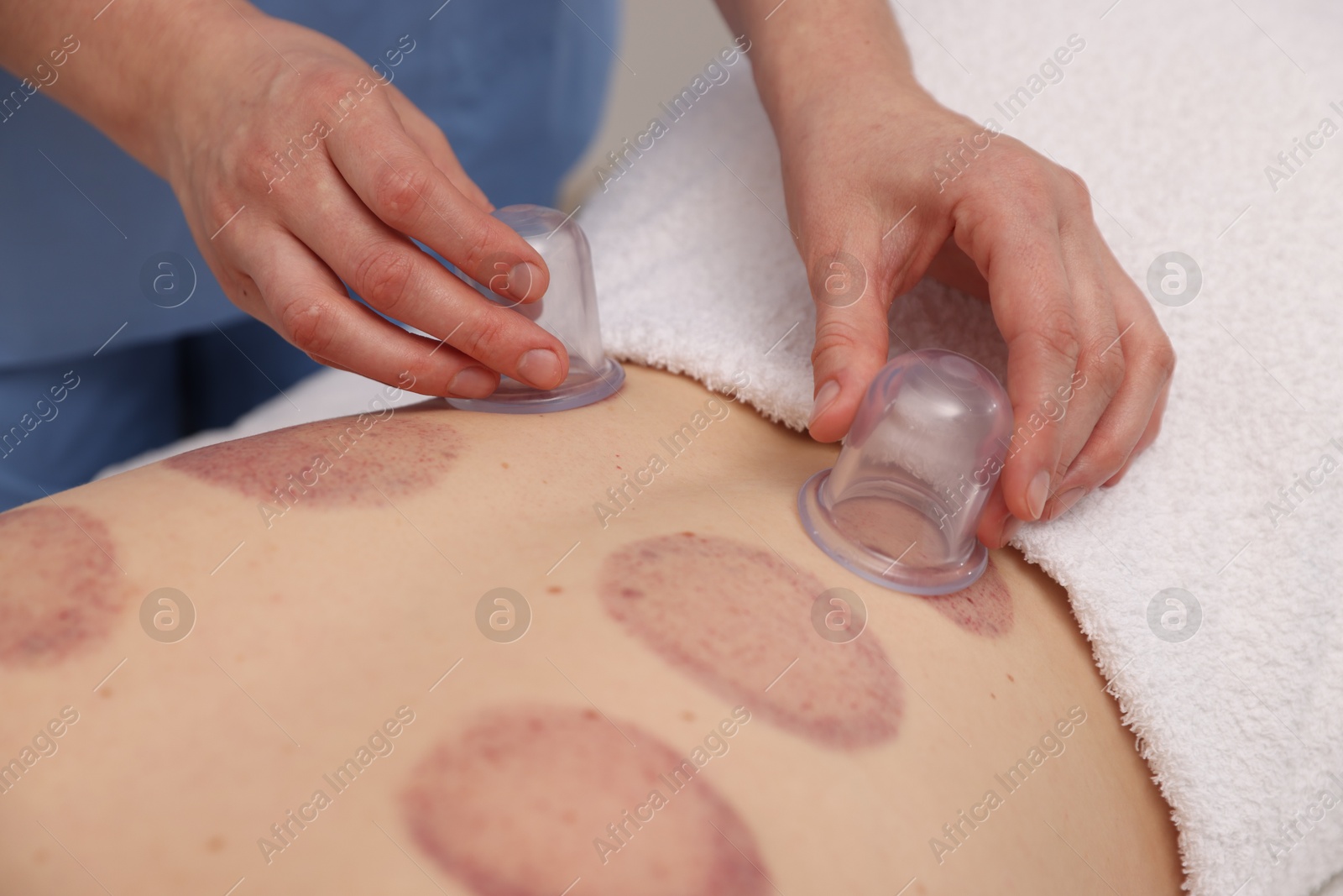 Therapist giving cupping treatment to patient in spa salon, closeup Photo of Therapist giving cupping treatment to patient in spa salon, closeup