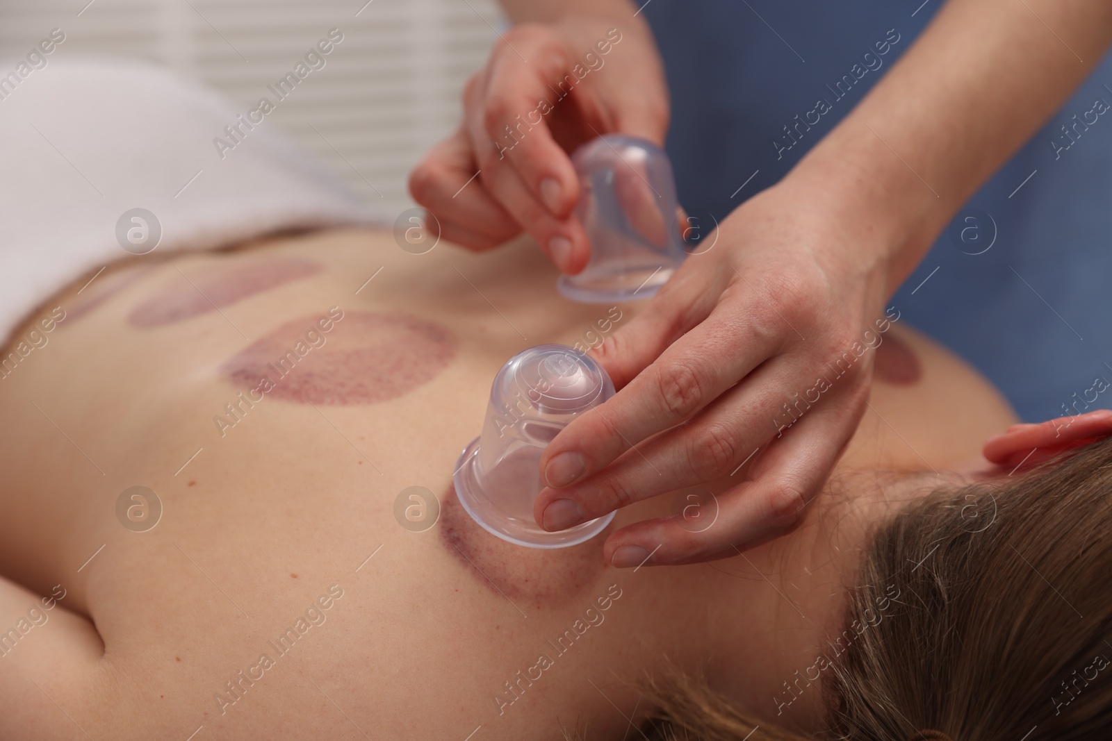 Therapist giving cupping treatment to patient in spa salon, closeup Photo of Therapist giving cupping treatment to patient in spa salon, closeup