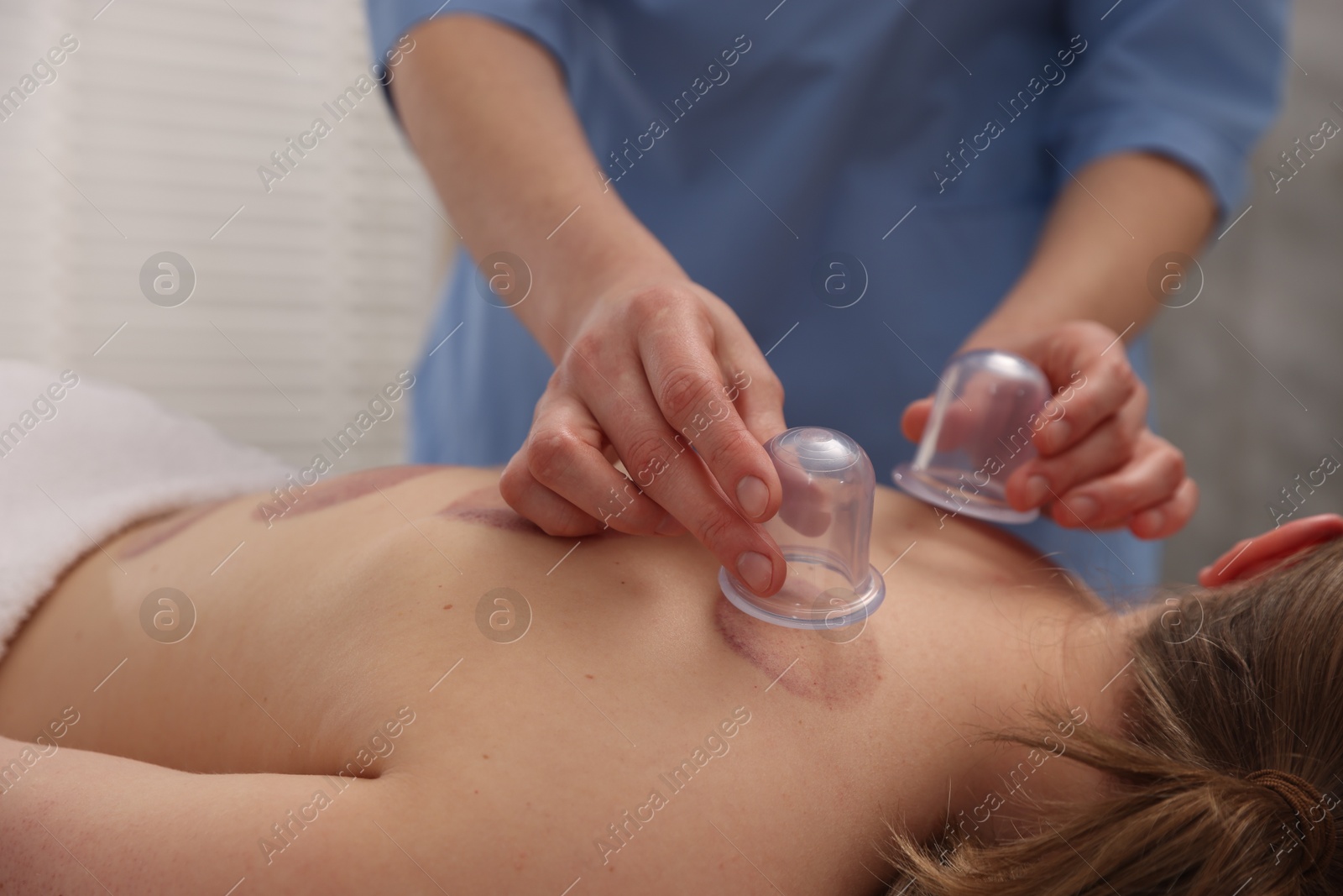Therapist giving cupping treatment to patient in spa salon, closeup Photo of Therapist giving cupping treatment to patient in spa salon, closeup