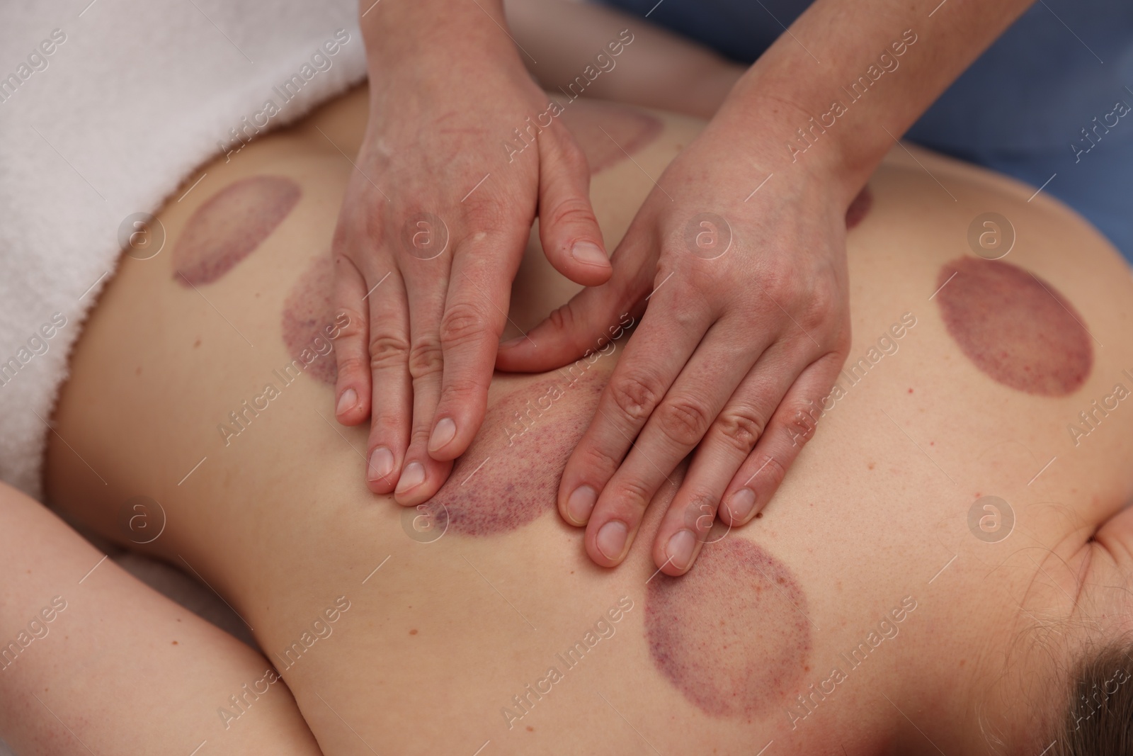 Cupping therapy. Woman receiving professional massage in spa salon, closeup Photo of Cupping therapy. Woman receiving professional massage in spa salon, closeup