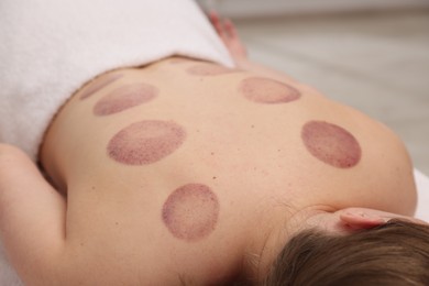 Photo of Woman after cupping therapy in spa salon, closeup
