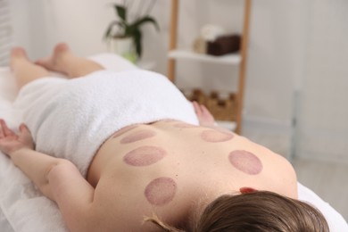 Photo of Woman after cupping therapy in spa salon