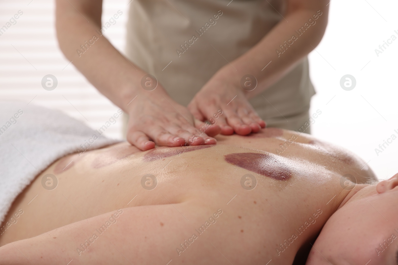Cupping therapy. Woman receiving professional massage in spa salon, closeup Photo of Cupping therapy. Woman receiving professional massage in spa salon, closeup