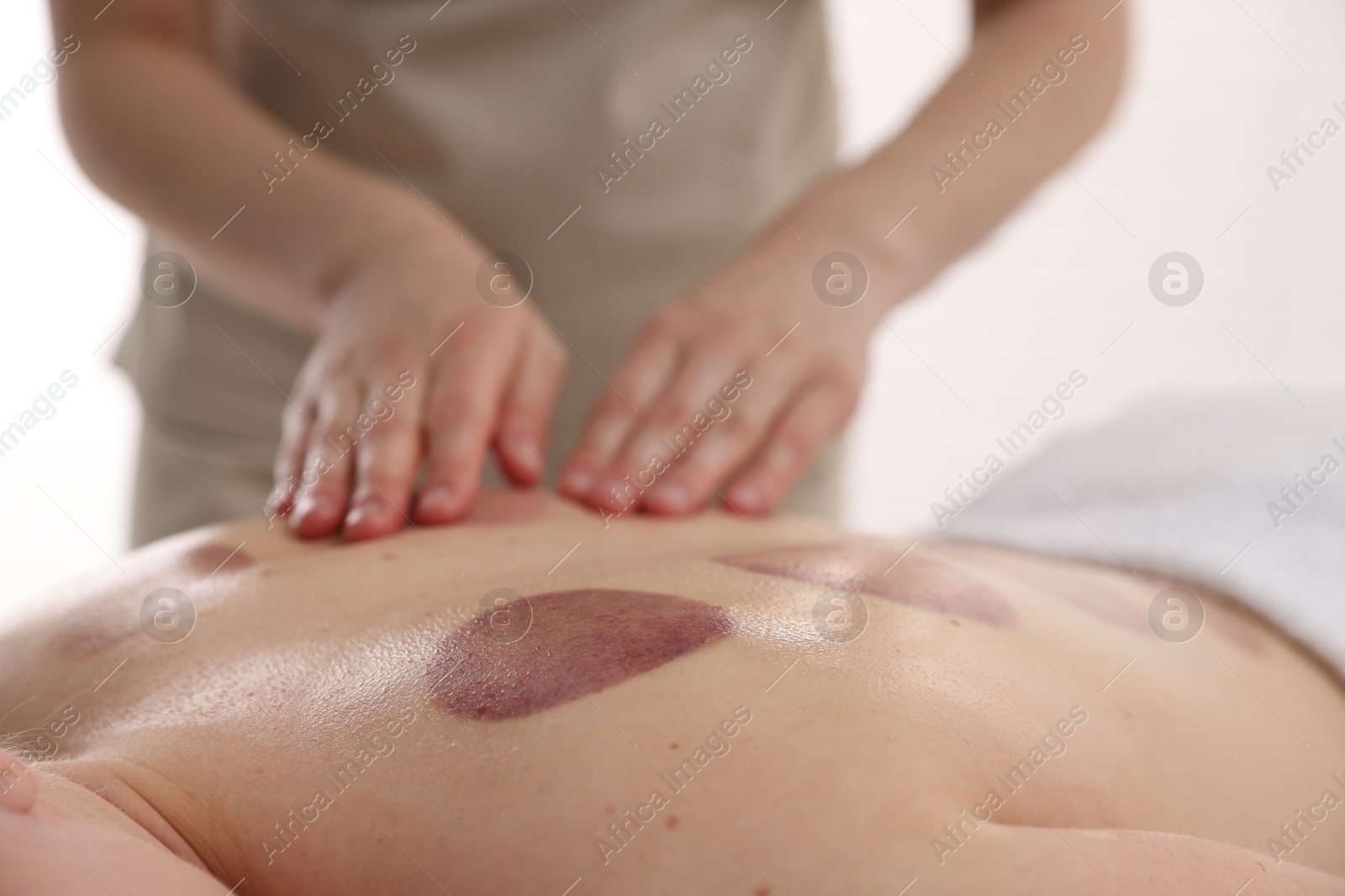 Cupping therapy. Woman receiving professional massage in spa salon, closeup Photo of Cupping therapy. Woman receiving professional massage in spa salon, closeup