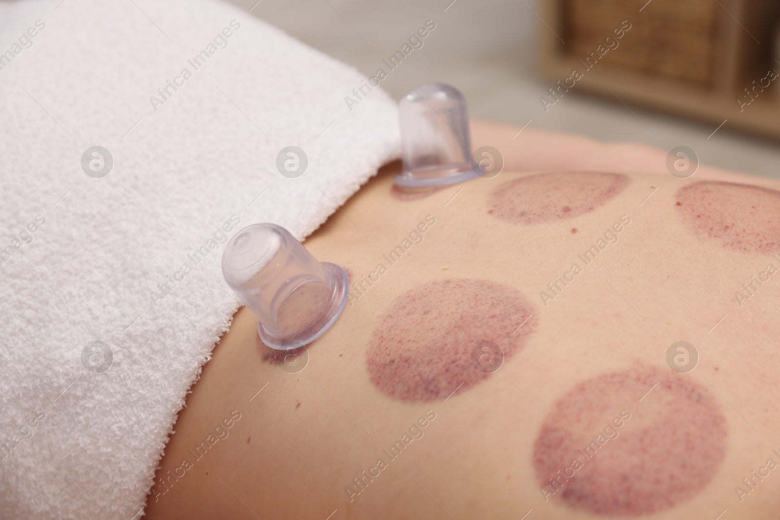 Cupping therapy. Woman with plastic cups on her back in spa salon, closeup Photo of Cupping therapy. Woman with plastic cups on her back in spa salon, closeup