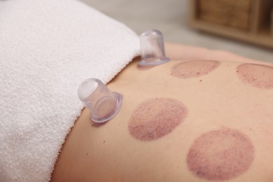 Photo of Cupping therapy. Woman with plastic cups on her back in spa salon, closeup