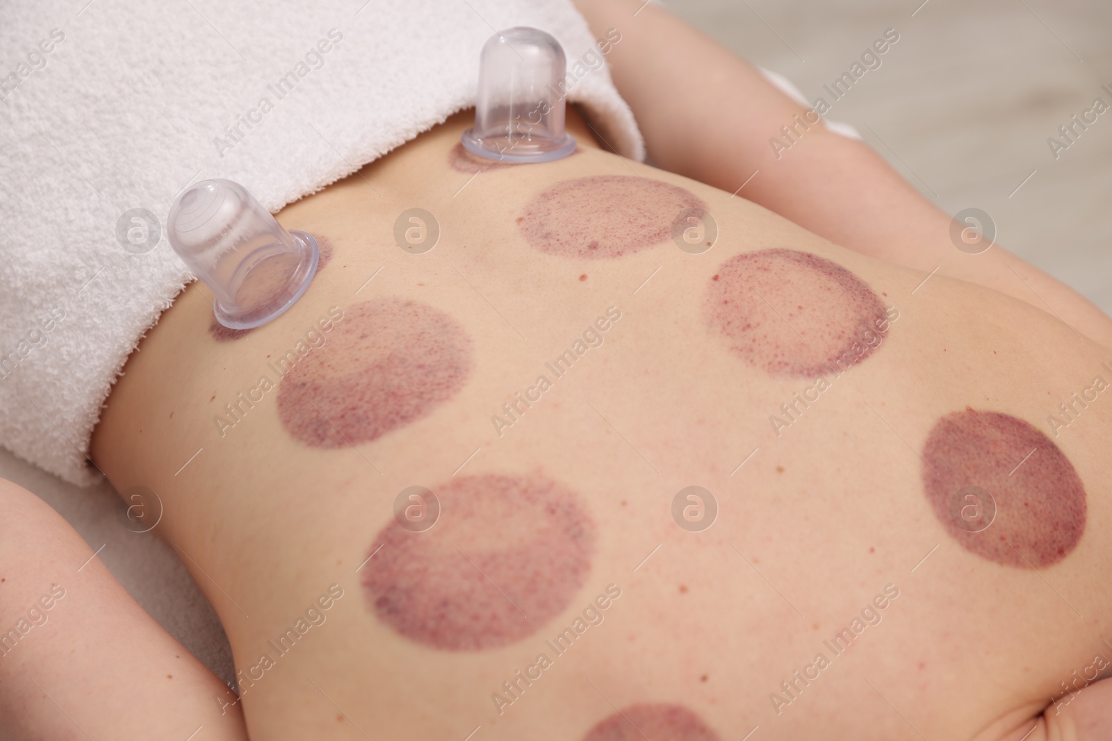 Cupping therapy. Woman with plastic cups on her back in spa salon, closeup Photo of Cupping therapy. Woman with plastic cups on her back in spa salon, closeup