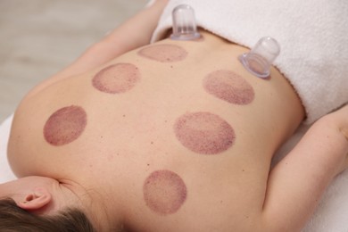 Photo of Cupping therapy. Woman with plastic cups on her back in spa salon, closeup