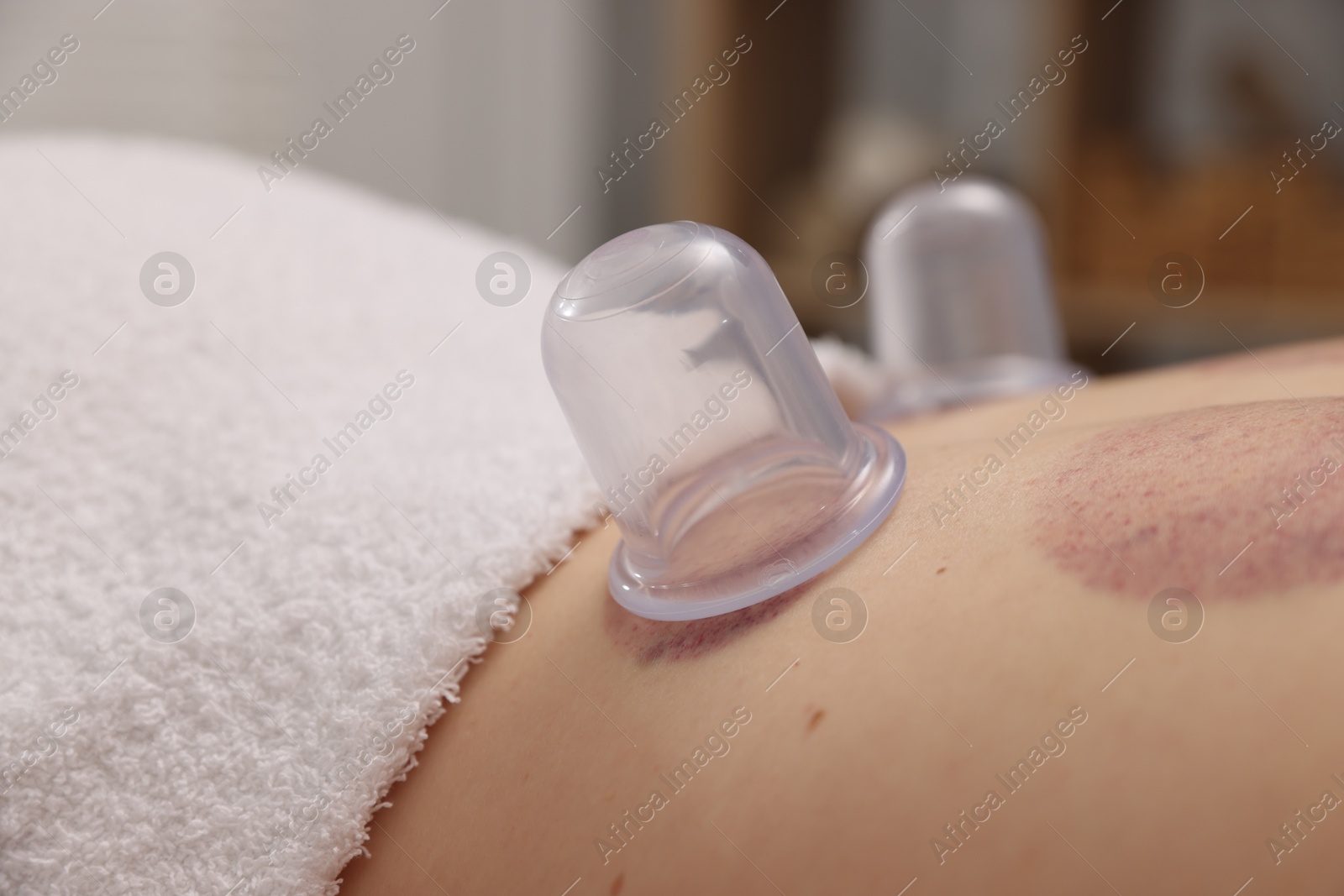 Cupping therapy. Woman with plastic cups on her back in spa salon, closeup Photo of Cupping therapy. Woman with plastic cups on her back in spa salon, closeup