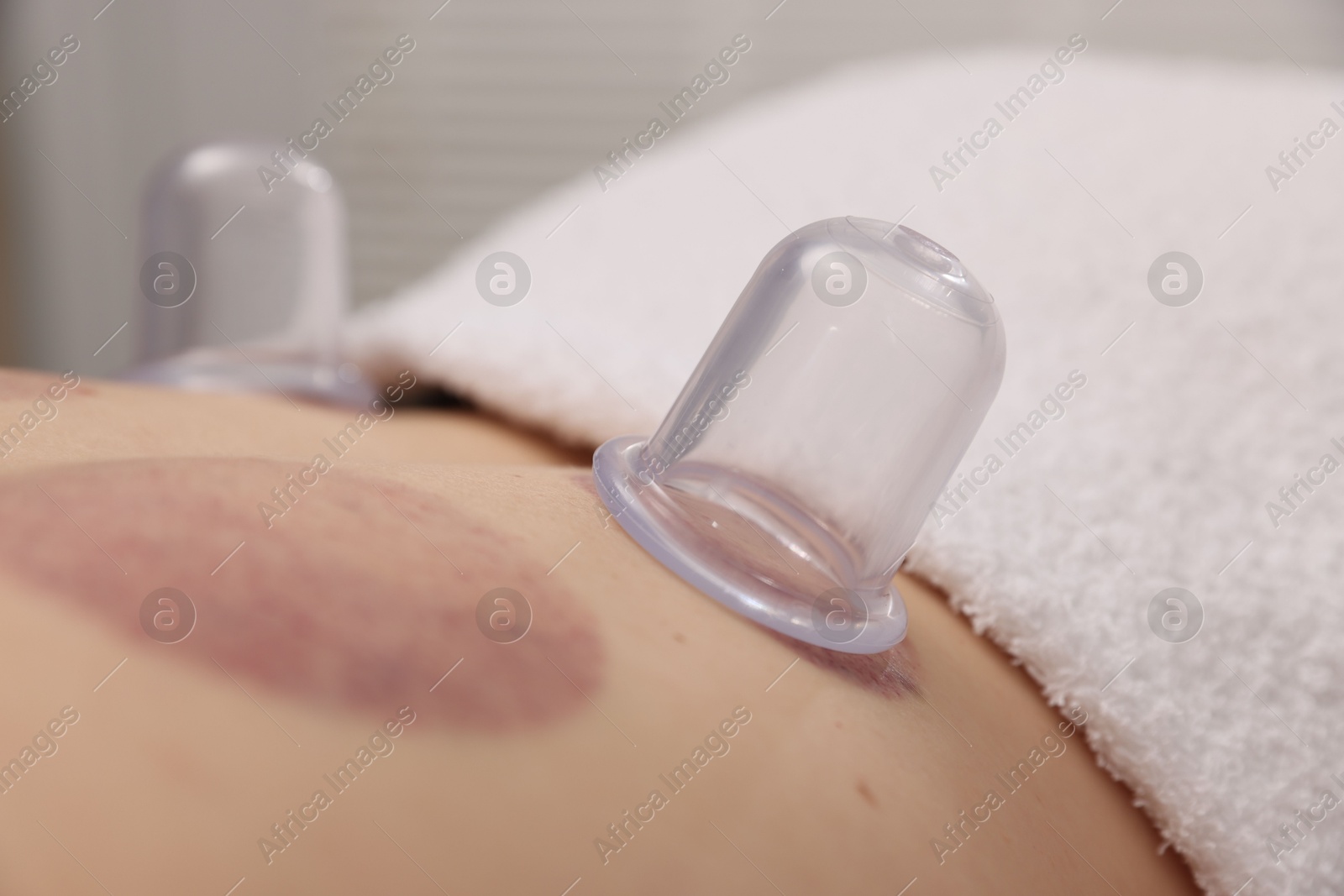 Cupping therapy. Woman with plastic cups on her back in spa salon, closeup Photo of Cupping therapy. Woman with plastic cups on her back in spa salon, closeup