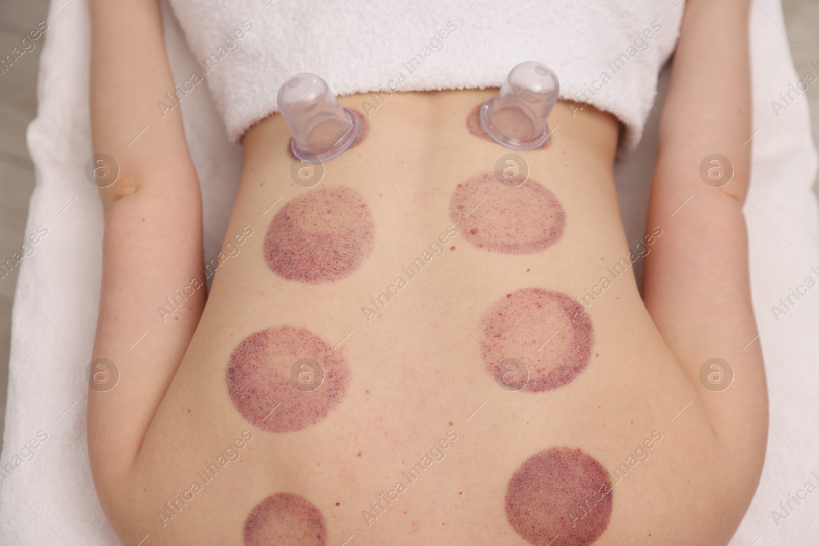 Cupping therapy. Woman with cups in spa salon, top view Photo of Cupping therapy. Woman with cups in spa salon, top view