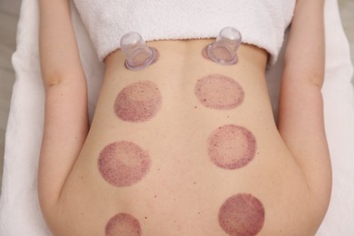 Photo of Cupping therapy. Woman with cups in spa salon, top view