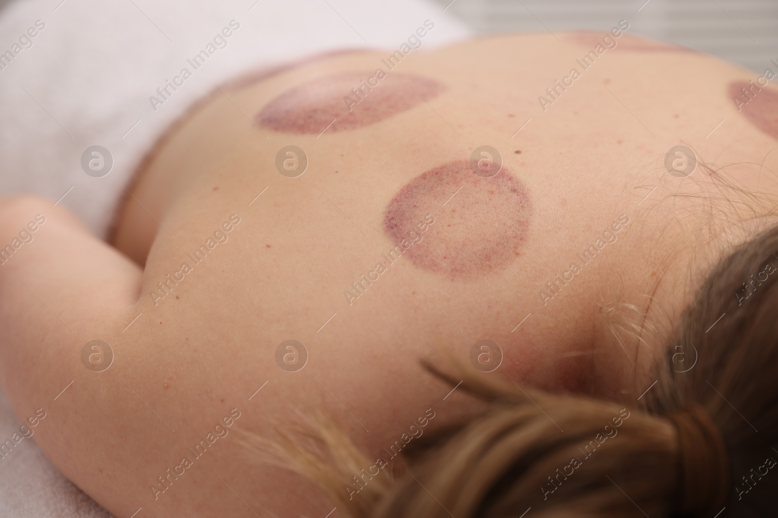 Woman after cupping therapy in spa salon, closeup Photo of Woman after cupping therapy in spa salon, closeup